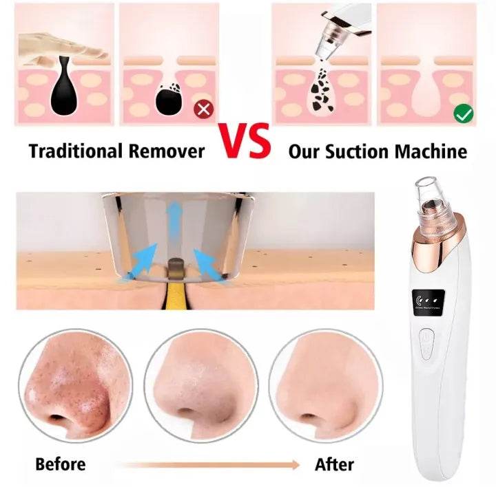 Acne Pore Cleaner & Black Head Remover
