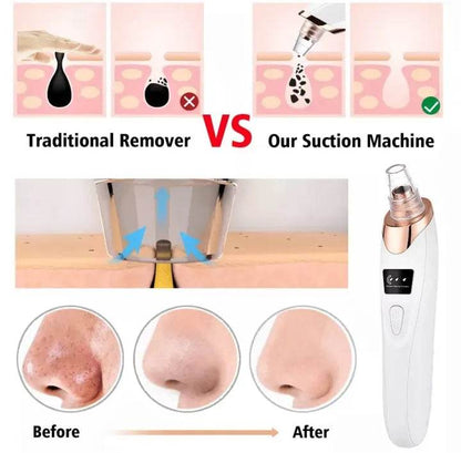 Acne Pore Cleaner & Black Head Remover